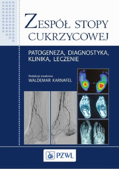 Waldemar Karnafel - Zespół stopy cukrzycowej