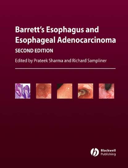 Prateek  Sharma - Barrett's Esophagus and Esophageal Adenocarcinoma