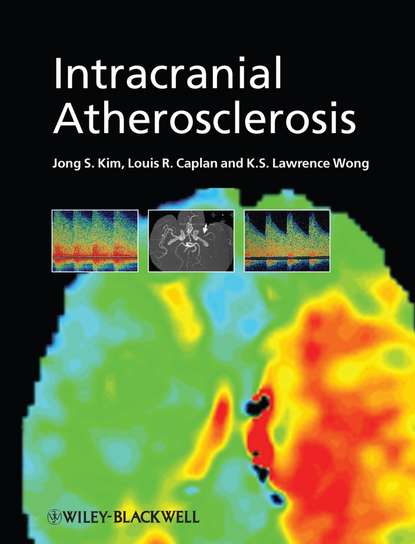 Intracranial Atherosclerosis - Jong Kim S.