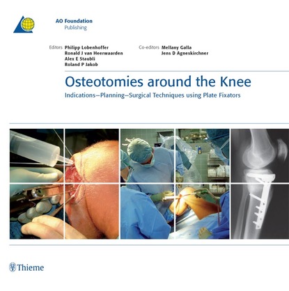 Ronald J. van Heerwaarden - Osteotomies around the Knee