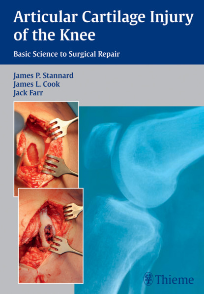 Группа авторов - Articular Cartilage Injury of the Knee: Basic Science to Surgical Repair