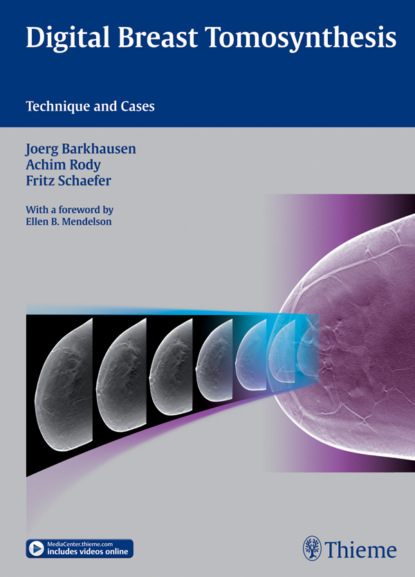 Joerg Barkhausen - Digital Breast Tomosynthesis